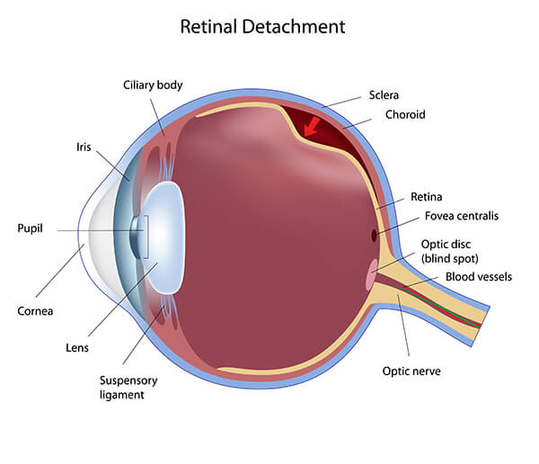 Retinal Detachment Portland